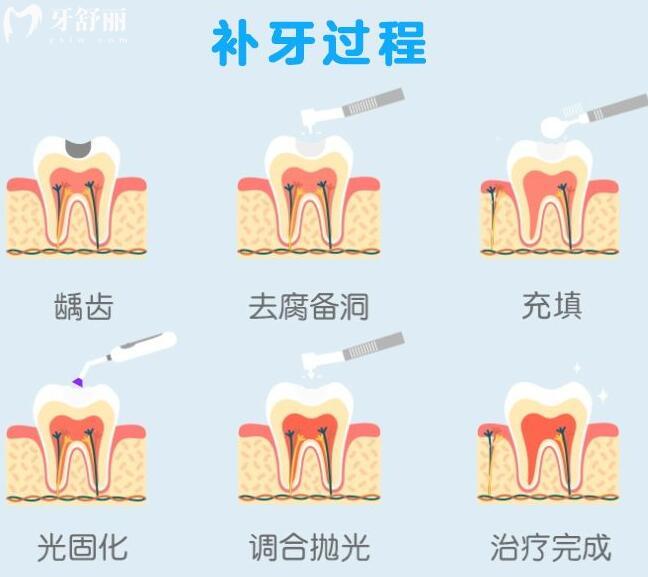 補(bǔ)牙收費(fèi)價(jià)目表