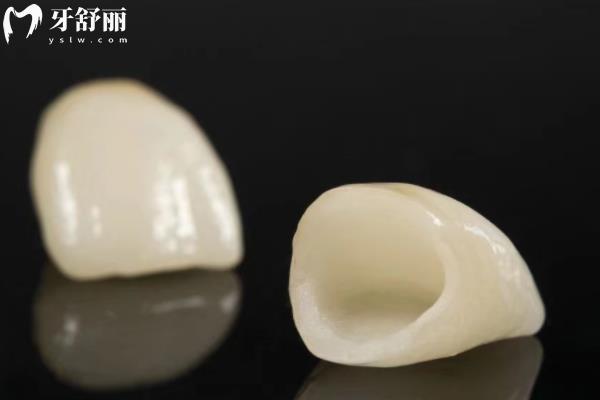 全瓷牙冠