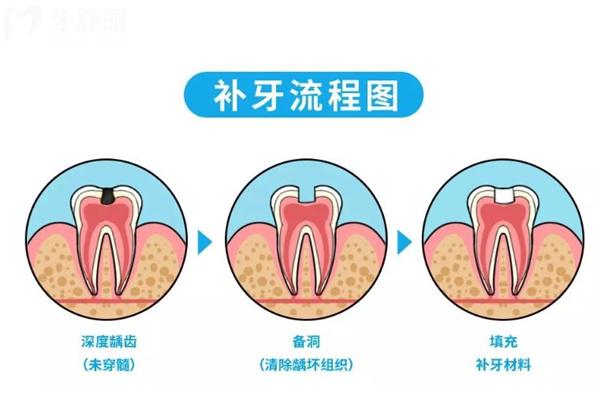 補(bǔ)牙流程圖