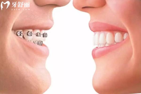 牙齒矯正圖