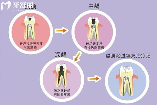 根管治療