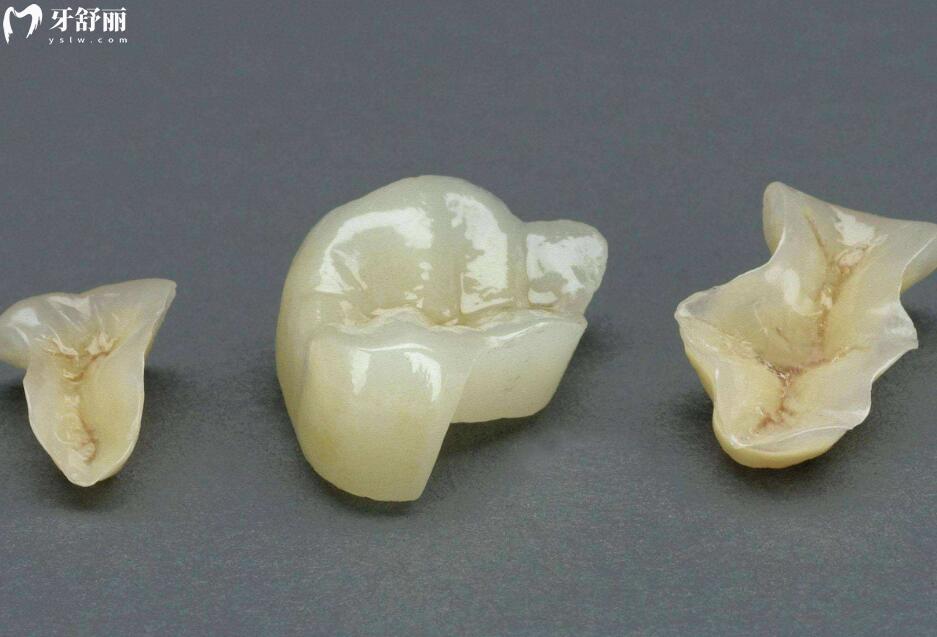 北海諾貝爾口腔嵌體補牙