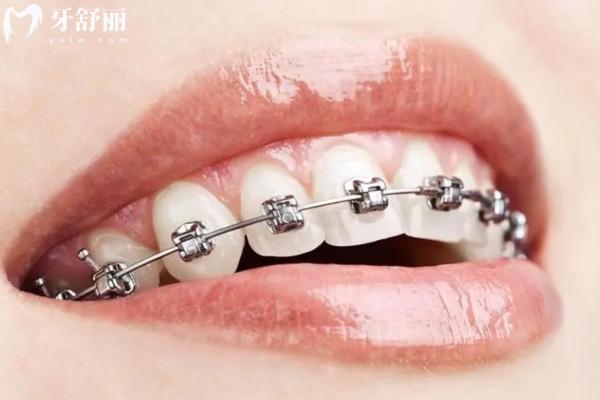 濟(jì)南牙齒矯正價格