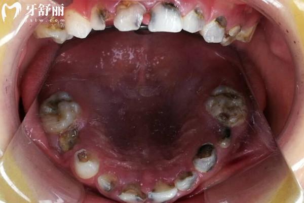 20歲牙齒全爛了不想活了