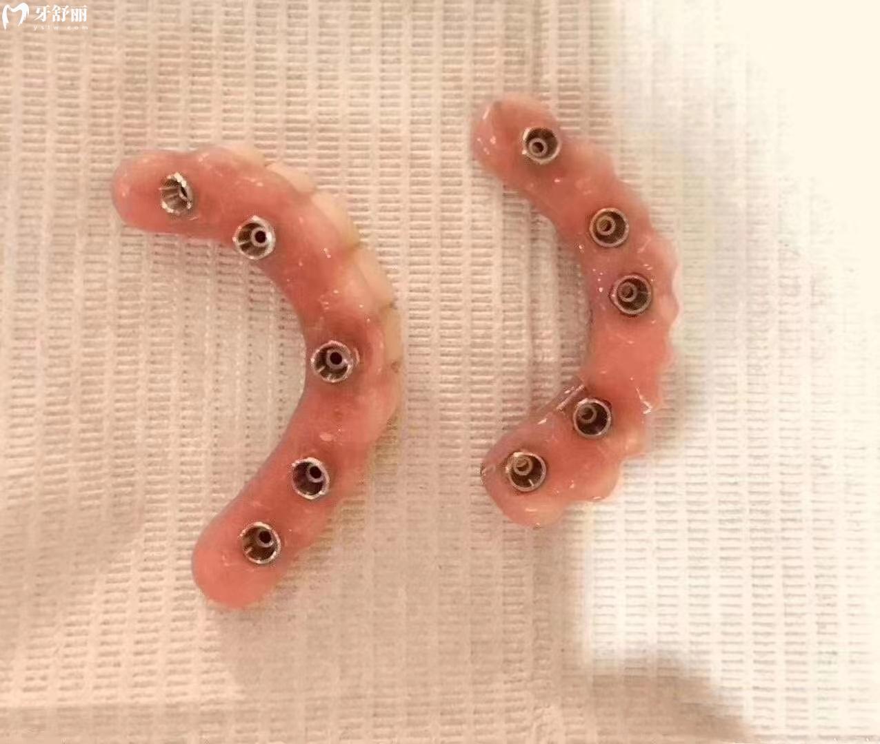 全口種植牙