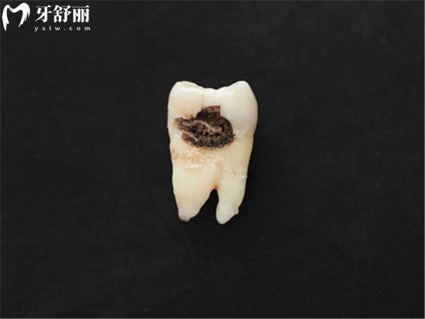 蛀牙不處理時間久了會怎么樣