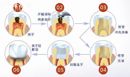 中山牙科醫(yī)院收費(fèi)價目表已出,拔智齒350種植牙2880矯正5500