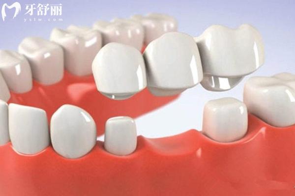 石家莊市**全瓷牙價(jià)格