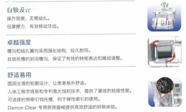 Damon Clear陶瓷自鎖托槽性能優(yōu)勢