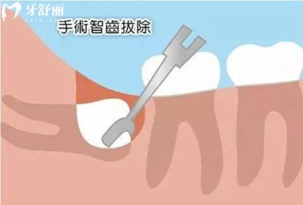 拔智齒