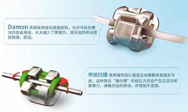 自鎖矯正