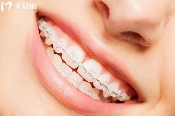陶瓷托槽隱形牙齒矯正