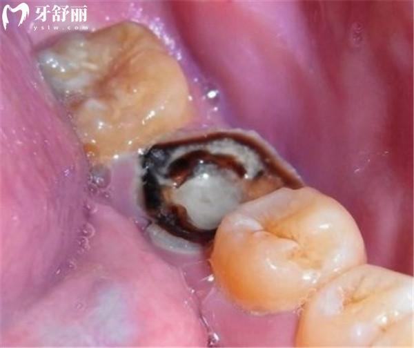 爛牙根長(zhǎng)期不拔的危害