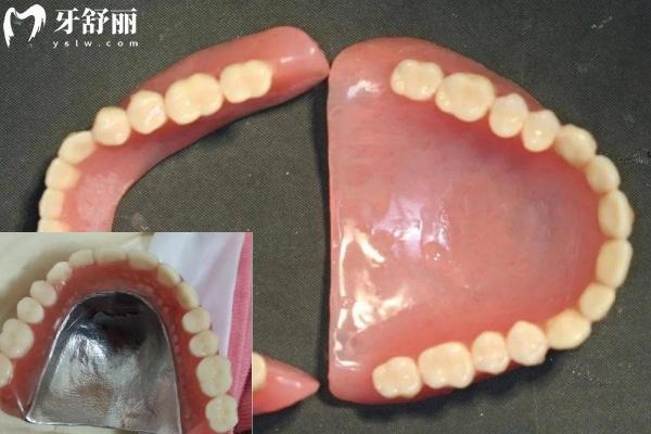 樹(shù)脂假牙和金屬底托樹(shù)脂假牙