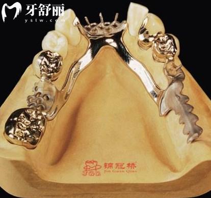金屬支架假牙