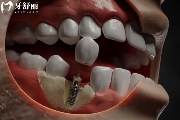 種植牙修復(fù)手術(shù)