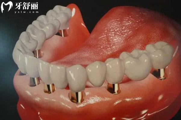 北京延慶區(qū)半口種植牙多少錢