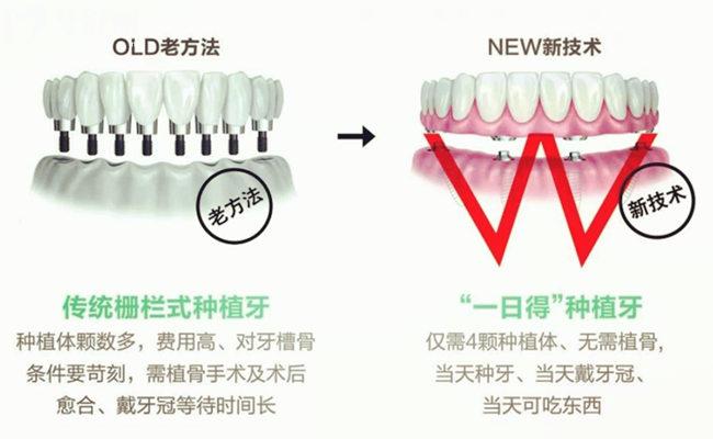 北京延慶區(qū)全口種植牙多少錢
