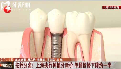 上海種植牙集采降價通知