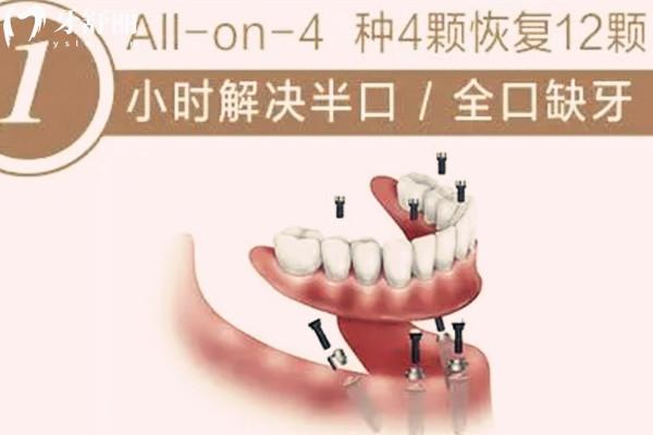 濱海新區(qū)半口種植牙價(jià)格