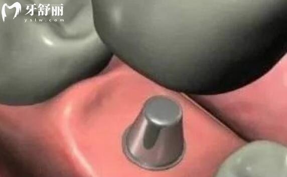 牙齦沒有了還可以種牙嗎？種一顆牙齒大概多少錢？