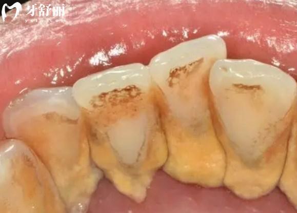 牙結(jié)石暴露很尷尬怎么辦?良心牙醫(yī)勸你定期洗牙好好刷牙