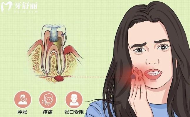 根尖周炎能自愈嗎