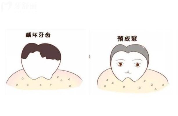 兒童乳牙做預(yù)成冠的利弊