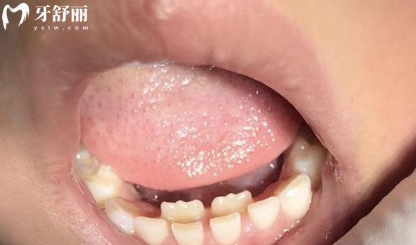 導(dǎo)致孩子雙排牙的原因