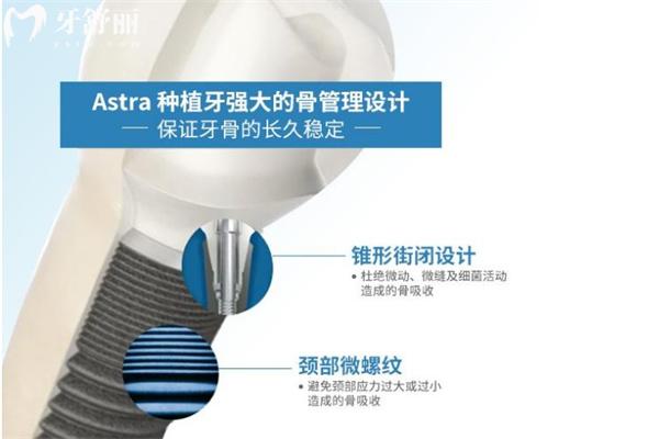 瑞典Astra種植體
