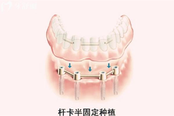 2024石家莊半口種植牙價格表
