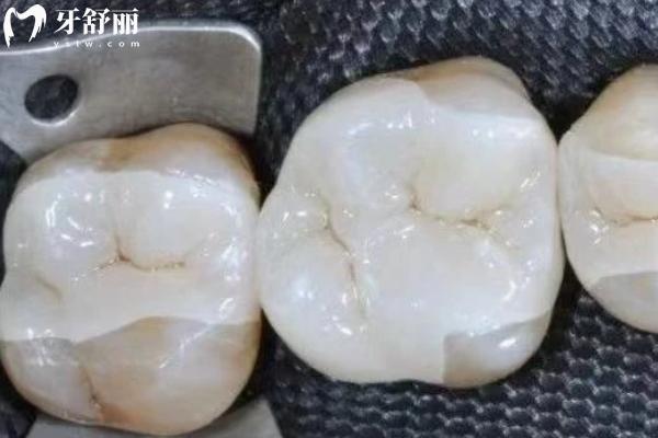 嵌體修復(fù)和牙冠哪個好
