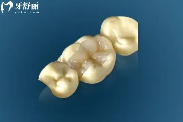 嵌體修復(fù)和牙冠哪個好