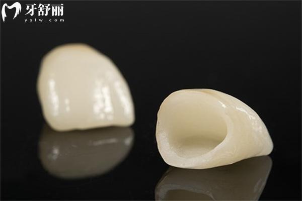 全瓷牙冠