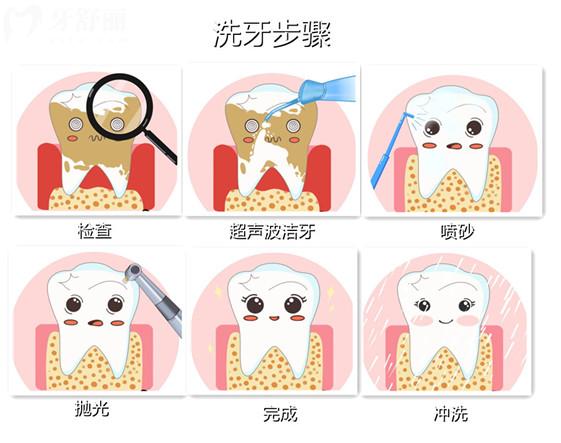 洗牙加噴砂是什么意思