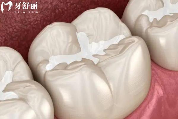 家長(zhǎng)問(wèn)窩溝封閉有必要嗎