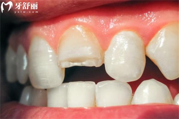牙齒斷了
