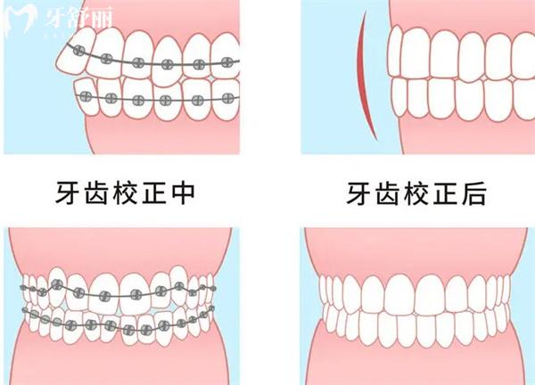 牙齒矯正圖