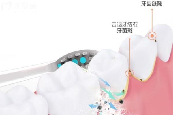 電動牙刷怎么選擇有什么講究