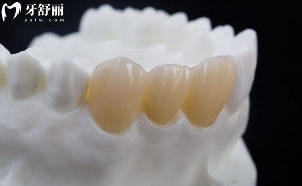 裝全瓷牙為什么會(huì)失敗