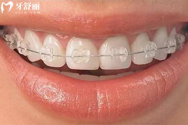 牙齒矯正越疼越有療效嗎