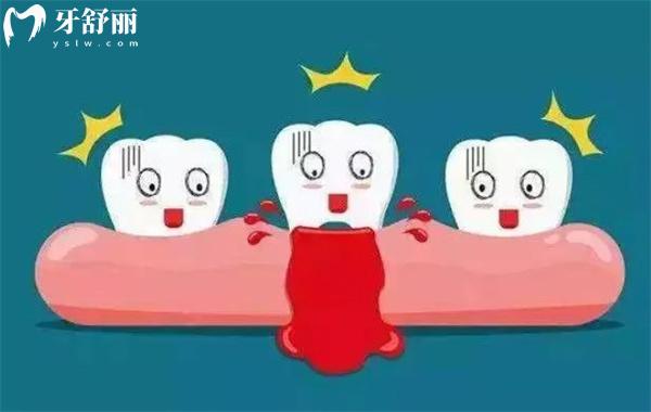 牙周炎