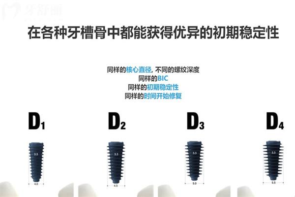 韓國美格真植體怎么樣