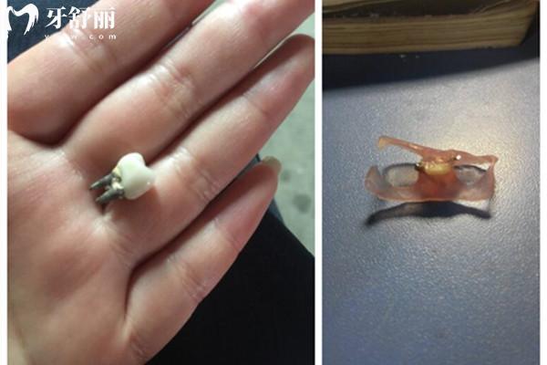 拔牙后多久裝假牙？一分鐘讓你掌握口腔小知識