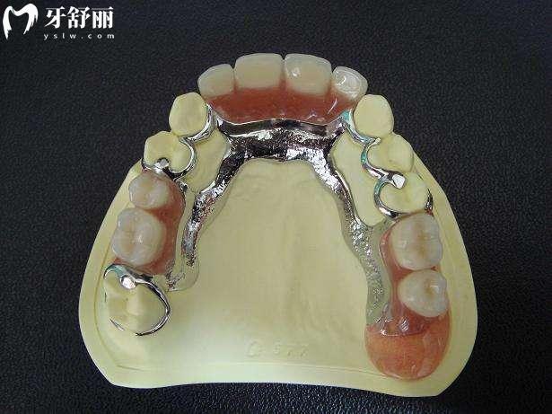 拔牙后多久裝假牙？一分鐘讓你掌握口腔小知識