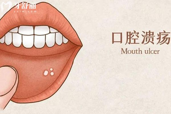 口腔潰瘍