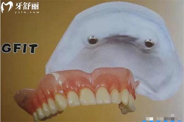 老人裝全口半固定種植牙多少錢