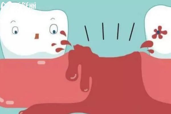 經(jīng)期為什么不能拔牙