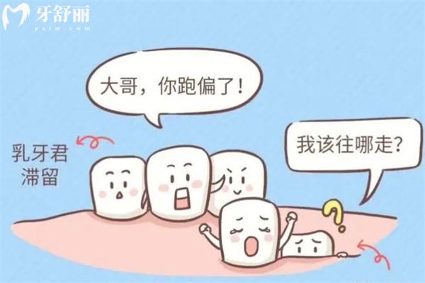 乳牙滯留