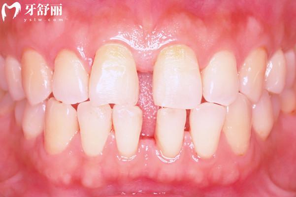 關(guān)閉門(mén)牙牙縫的解決方案